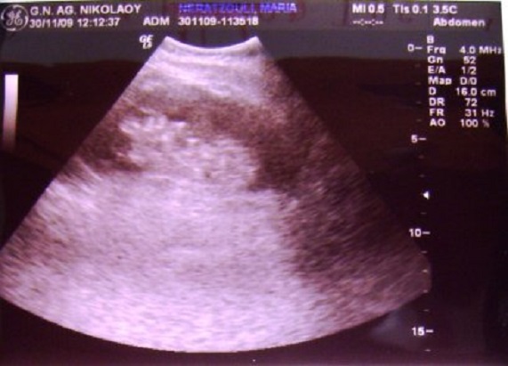 Echografie van Ans. Knap als je de drie steentjes in het nierbekken ziet