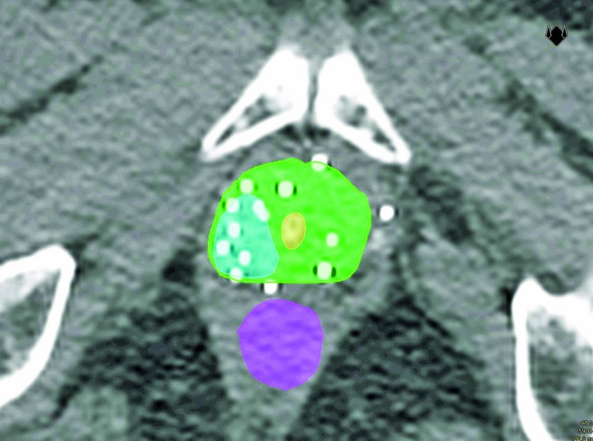  CT-scan prostaat.. Groen: hele prostaat; blauw: teruggekeerde tumor; paars: endeldarm; geel plasbuis. Zie de goudmarkers van de 1e bestraling en de geplaatste flexibele katheters in de teruggekeerde tumor (witte bolletjes). (foto Prostaatstichting)